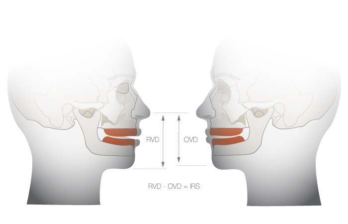 1120-vertical-dimension.png 1120-vertical-dimension.png