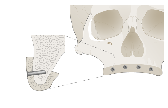 3067-grafting-upper-jaw-1.png 3067-grafting-upper-jaw-1.png