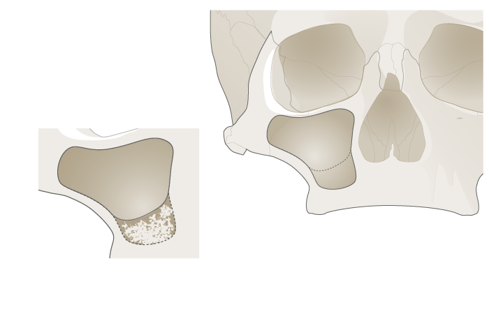 3067-grafting-upper-jaw-2.png 3067-grafting-upper-jaw-2.png
