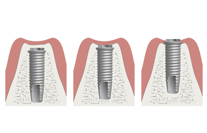 3420-Placement-of-implant-height.png 3420-Placement-of-implant-height.png