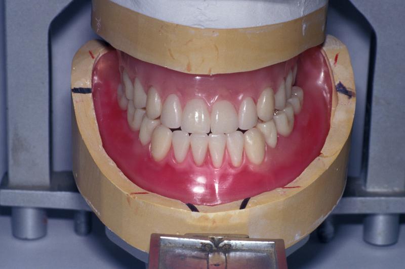 Rayspees wax trial dentures.jpg Rayspees wax trial dentures.jpg