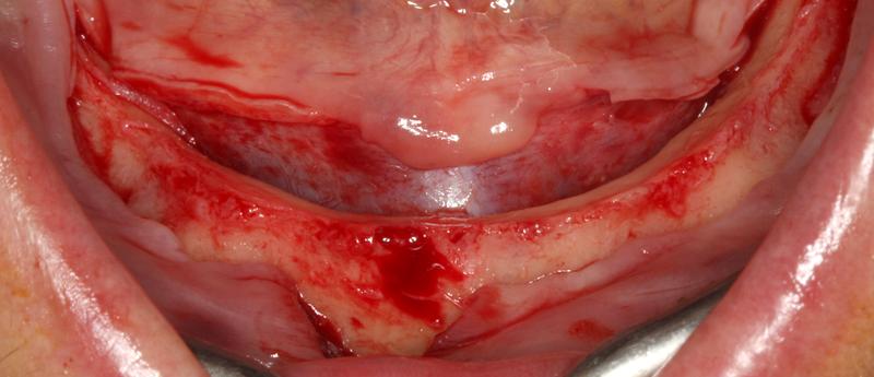 incision3.jpg incision3.jpg