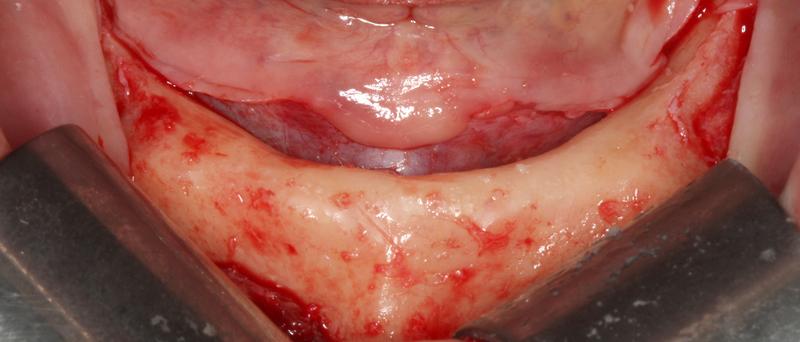 incision4.jpg incision4.jpg