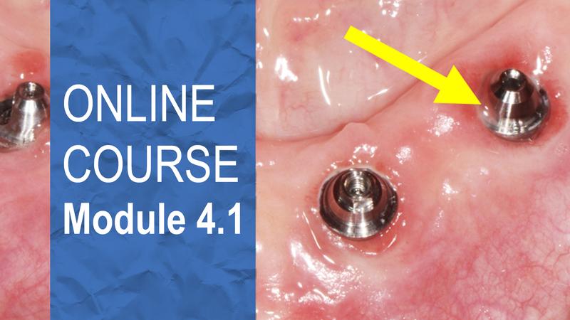 Maintenance protocal and how to take a final impression Maintenance protocal and how to take a final impression