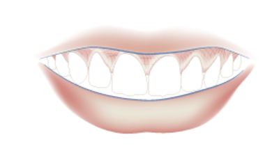 1110-lipline.png