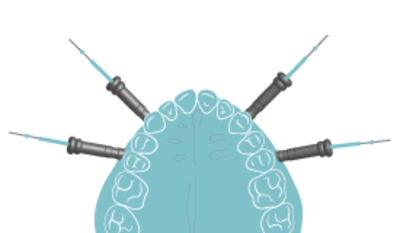 1500_1380-splints.png