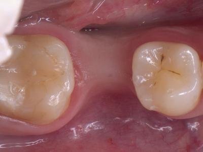 2 Occlusal view
