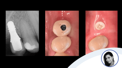 Clinical case by Dr. Dena Hashim