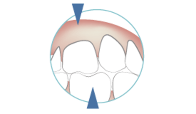2125-occlusal-schemes.png