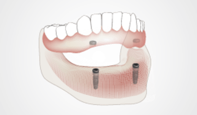 2310-Thumb-implant-overdentures.png