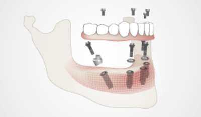2320-Thumb_Fixed-implant-protheses.png