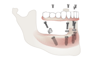 2320-fixed-implant.png