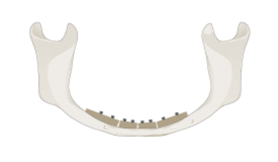3066-grafting-mandible.png