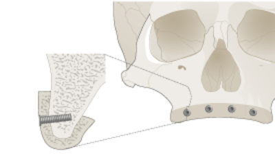 3067-grafting-upper-jaw.png