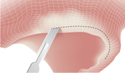 3110-Crestal-Incision.png