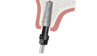 3220-tapered-implant-placement.png