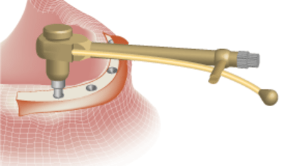 3410-Placement-of-implants---Torque.png