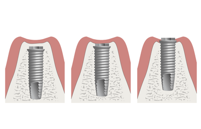 3420-Placement-of-implant-height.png