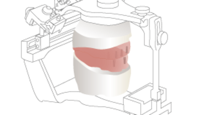 3620-Implant-overdenture-maxillo-mandibular-relations-.png