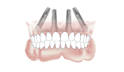 3634-Implant-overdenture-placement.png