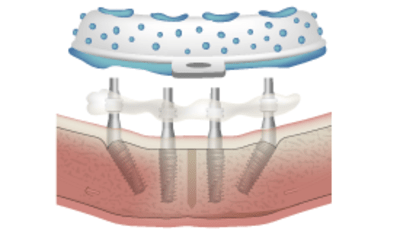 3812-splinted-vs-unsplinted-impression-copings.png