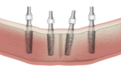 3816-parallel-vs-non-parallel-implants-.png