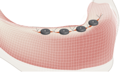 4120-Postoperative-soft-tissue-management.png