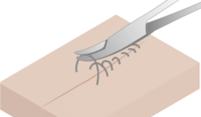 4130-suture-removal.png