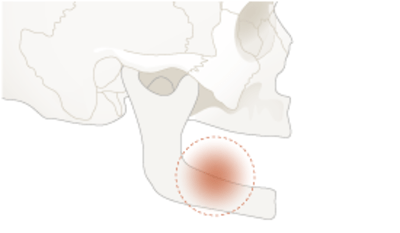 4460-Inflammation-infection.png