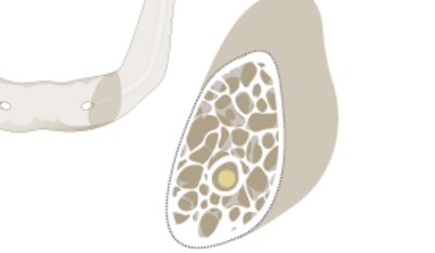 Osteoporosis.png