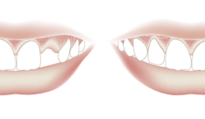 TG2_1110_thumb_Benefits_of_single_implants.png