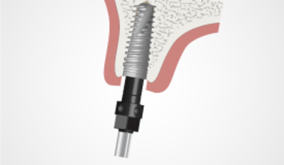 TG2_4152_Thumb-tapered-implant-placement.png