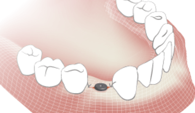 TG2_5120_thumb_Postoperative-soft_tissue_management.png