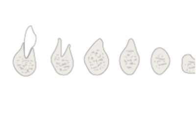 Thumb_Alveolar_atrophy.png